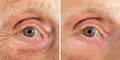 Senior Woman`s Eye With And Without Wrinkles