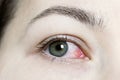 Close up of a severe bloodshot red eye. Viral Blepharitis, Conjunctivitis, Adenoviruses. Irritated or infected eye. Royalty Free Stock Photo