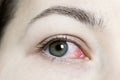 Close up of a severe bloodshot red eye. Viral Blepharitis, Conjunctivitis, Adenoviruses. Irritated or infected eye.