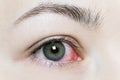 Close up of a severe bloodshot red eye. Viral Blepharitis, Conjunctivitis, Adenoviruses. Irritated or infected eye.