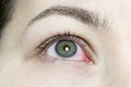 Close up of a severe bloodshot red eye. Viral Blepharitis, Conjunctivitis, Adenoviruses. Irritated or infected eye. Royalty Free Stock Photo