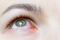 Close up of a severe bloodshot red eye. Viral Blepharitis, Conjunctivitis, Adenoviruses. Irritated or infected eye. Royalty Free Stock Photo