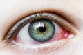 Close up of a severe bloodshot red eye. Viral Blepharitis, Conjunctivitis, Adenoviruses. Irritated or infected eye. Royalty Free Stock Photo