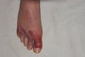 a human foot showing injured toes on light background