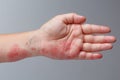 Shingles, Zoster or Herpes Zoster symptoms on arm