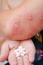 Shingles, Zoster or Herpes Zoster symptoms with antiviral drug Royalty Free Stock Photo