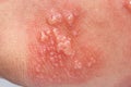 Shingles, Zoster or Herpes Zoster symptoms on arm Royalty Free Stock Photo