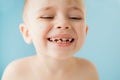 Close up shot of baby teeth with caries Royalty Free Stock Photo