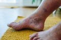 A close-up shot of man& x27;s feet with diabetic foot complications. Royalty Free Stock Photo