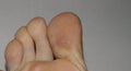 Close-up shot of a plantar wart on the bottom of the big toe caused by the human papillomavirus, or HPV Royalty Free Stock Photo