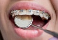 Close-up shot of teeth with braces. Smiling female patient with metal brackets at the dental office Royalty Free Stock Photo