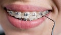 Close-up shot of teeth with braces. Female patient with metal brackets at the dental office. Orthodontic Treatment. Royalty Free Stock Photo