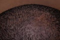 Close-Up Shot of Top of Head with Hair Loss Due to Fungus and Scaly Scalp