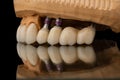 Close-up side view of a dental upper jaw prosthesis on black glass background. Artificial jaw with veneers and crowns