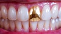 In a close-up, a single gold tooth gleams amid a row of pearly whites, adds a touch of contrast Royalty Free Stock Photo