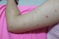 Close-up of the skin on the arm Of women with skin diseases, allergies, rash, redness, itching, skin disease concepts