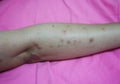 Close-up of the skin on the arm Of women with skin diseases, allergies, rash, redness, itching, skin disease concepts