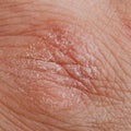 A close-up of the skin on the back of the fingers of the human hand