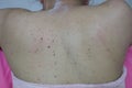 Close-up of the skin on the back  Of women with skin diseases, allergies, rash, redness, itching, skin disease concepts Royalty Free Stock Photo