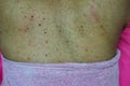 Close-up of the skin on the back  Of women with skin diseases, allergies, rash, redness, itching, skin disease concepts Royalty Free Stock Photo