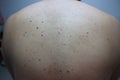 Close-up of the skin behind a woman with a birthmark, acne, freckles, skin ailments, skin diseases Royalty Free Stock Photo