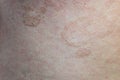 Close up skin disease Tinea versicolor/Pityriasis versicolor