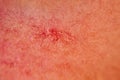 Close-up on the skin of the girl's face are visible couperose, red and dilated capillaries, spider veins, vascular Royalty Free Stock Photo