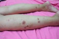 Close-up of skin on legs  Of women with skin diseases, allergies, rash, redness, itching, skin disease concepts Royalty Free Stock Photo