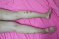 Close-up of skin on legs  Of women with skin diseases, allergies, rash, redness, itching, skin disease concepts Royalty Free Stock Photo