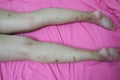 Close-up of skin on legs Of women with skin diseases, allergies, rash, redness, itching, skin disease concepts