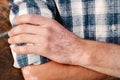 Close-up skin of a man`s hand with vitiligo symptoms Royalty Free Stock Photo