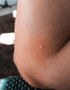Close-up of skin with a mosquito bite and reddened skin Royalty Free Stock Photo