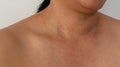 Close-up the skin tags on human skin, Asian woman middle age.