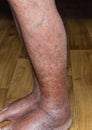 Close-up of skin with varicose veins Royalty Free Stock Photo