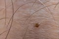 Close-up of a small tick attached to a person's skin