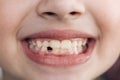 Close-up smile face of a child girl. A beautiful little girl 7-8 years old has lost milk teeth. Loss of milk teeth Royalty Free Stock Photo