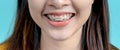 Close up Smiling Asian woman wearing orthodontic retainer on blue screen background. Dental care and teeth