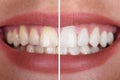 Woman`s Teeth Before And After Whitening Royalty Free Stock Photo