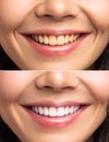 Close-up Of Smiling Woman Teeth Before And After Whitening