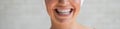 Close-up of a smiling woman in a transparent plastic bleaching tray. Removable retainer for perfectly straight teeth