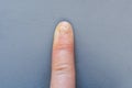 Close-up of a sore hand finger with a fungus on a gray background. Onycholysis: detachment of the nail from the nail bed