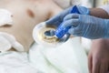 Close up stoma and colostomy after colon cancer surgery out.Cover stoma with one piece colostomy bag sticking - stoma patient care Royalty Free Stock Photo