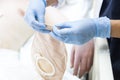 Close up stoma and colostomy after colon cancer surgery out.Cover stoma with one piece colostomy bag sticking - stoma patient care Royalty Free Stock Photo
