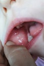 Close-up of stomatitis into mouth.Stomatitis viral genesis on the cheek of a child Royalty Free Stock Photo