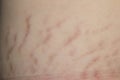 Close up stretch marks Royalty Free Stock Photo