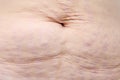 Close up stretch marks on belly Royalty Free Stock Photo