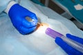 Close-up surgeon burns a mole on the back of the patient. Mole Removal Surgery Procedure