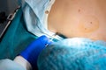 Close-up surgeon burns a mole on the back of the patient. Mole Removal Surgery Procedure