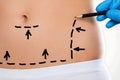 Surgeon Drawing Correction Lines On Woman\'s Stomach
