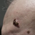 Close up of suspicious mole on skin